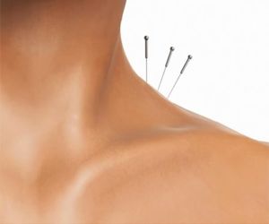 Acupuntura - Tratando a energia do corpo 