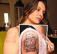 Remoção de Tatuagens