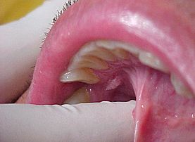 Virus de papiloma en boca